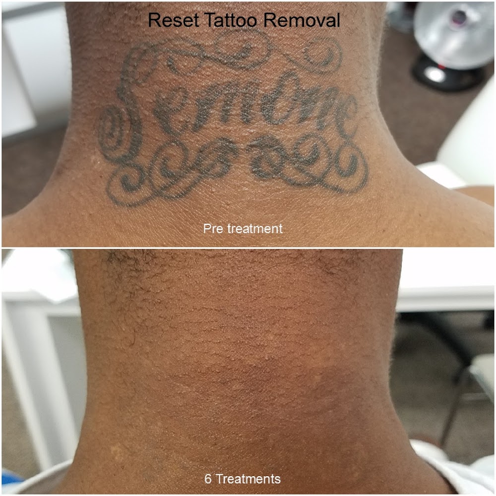 Reset Tattoo Removal